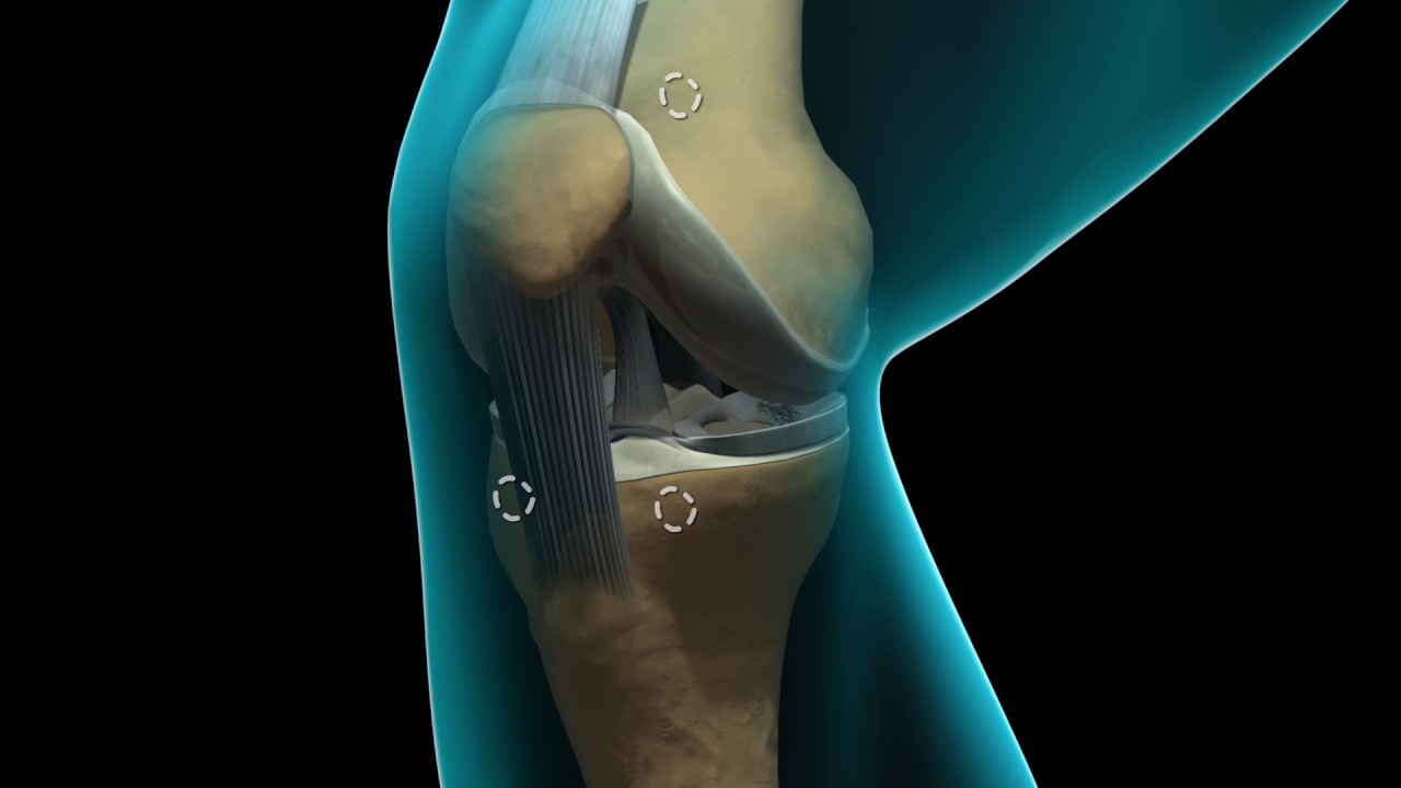 Learn about knee arthroscopy