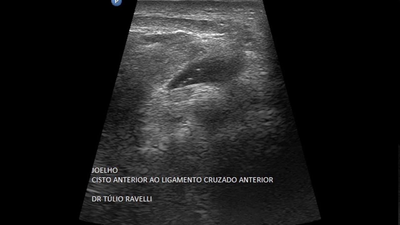 Ultrassonografia do Joelho
