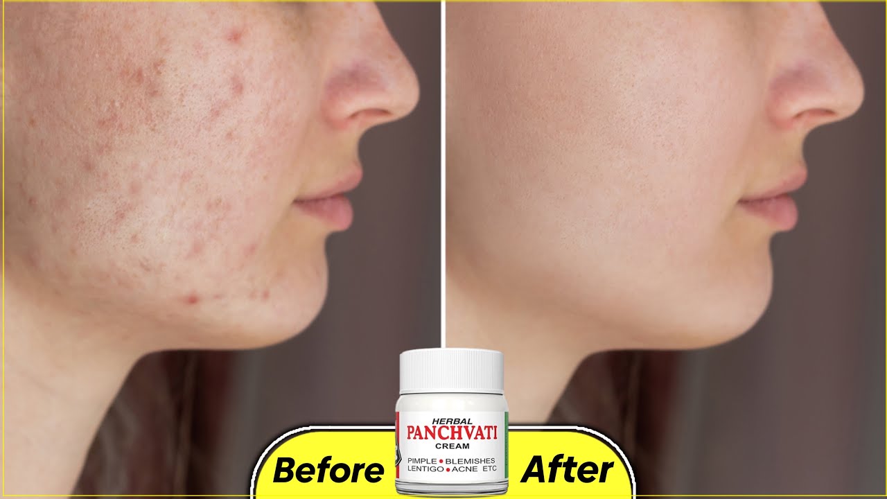 Panchvati cream🔥क़ैसे लगाए ताकी नुक़सान ना हो |How to use, benefits & Review in Hindi #glowingskin