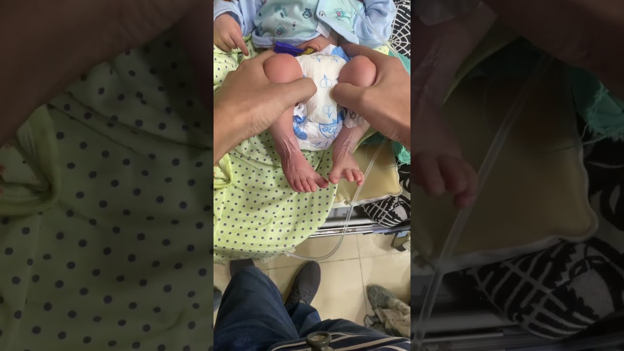 Barlow and ortolani maneuvers for developmental dysplasia of hip joint in a neonate.