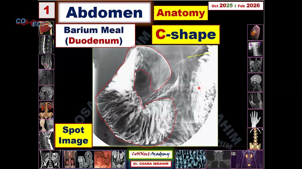 أصعب أجزاء فى  الـ Abdomen… هتلاقيها معاك خطوة بخطوة فى المحاضرة دى