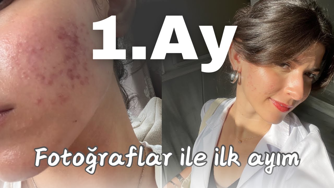 FOTOĞRAFLARLA SİVİLCE/AKNETRENT TEDAVİSİNDE 1.AYIM✨Nasıl karar verdim,kusma dönemi,yan etkiler