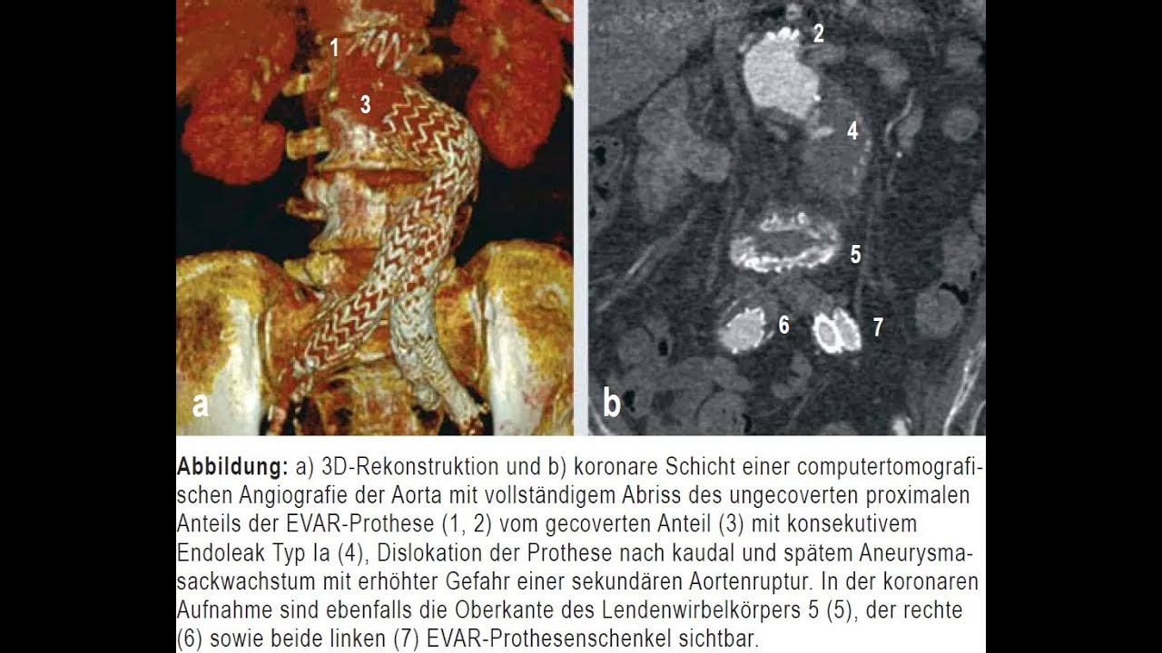 Materialerm&uuml;dung mit Endoleckage nach endovaskul&auml;rer Versorgung eines Bauchaortenaneurysmas