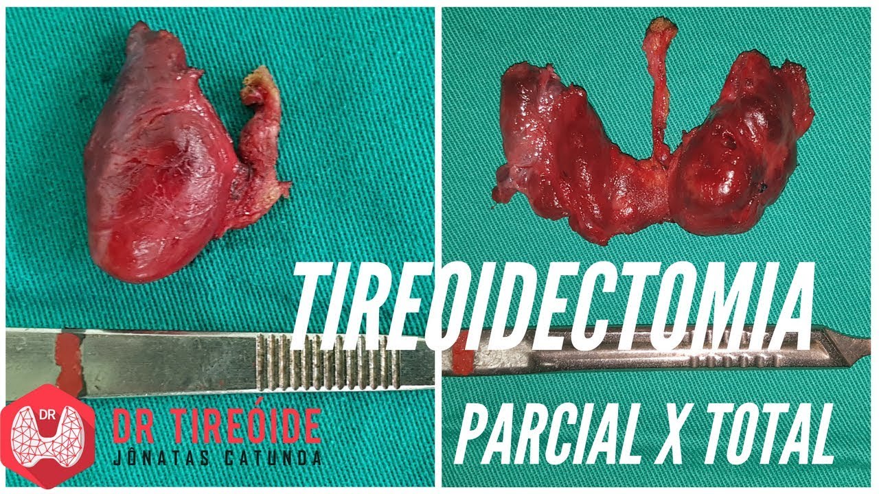 Tireoidectomia parcial ou Tireoidectomia total?  | Dr Jônatas Catunda