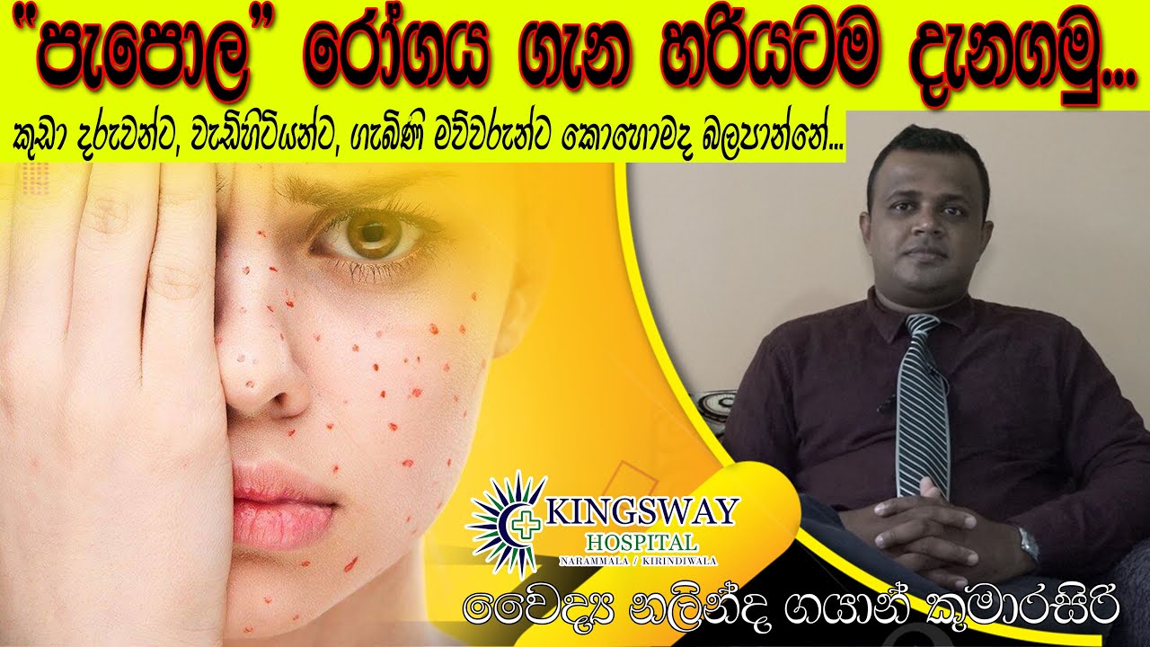 පැපොල රෝගය ගැන හරියටම දැනගමු. - වෛද්‍ය නලින්ද ගයාන් කුමාරසිරි.Papola rogaya gana hariyatama danagamu