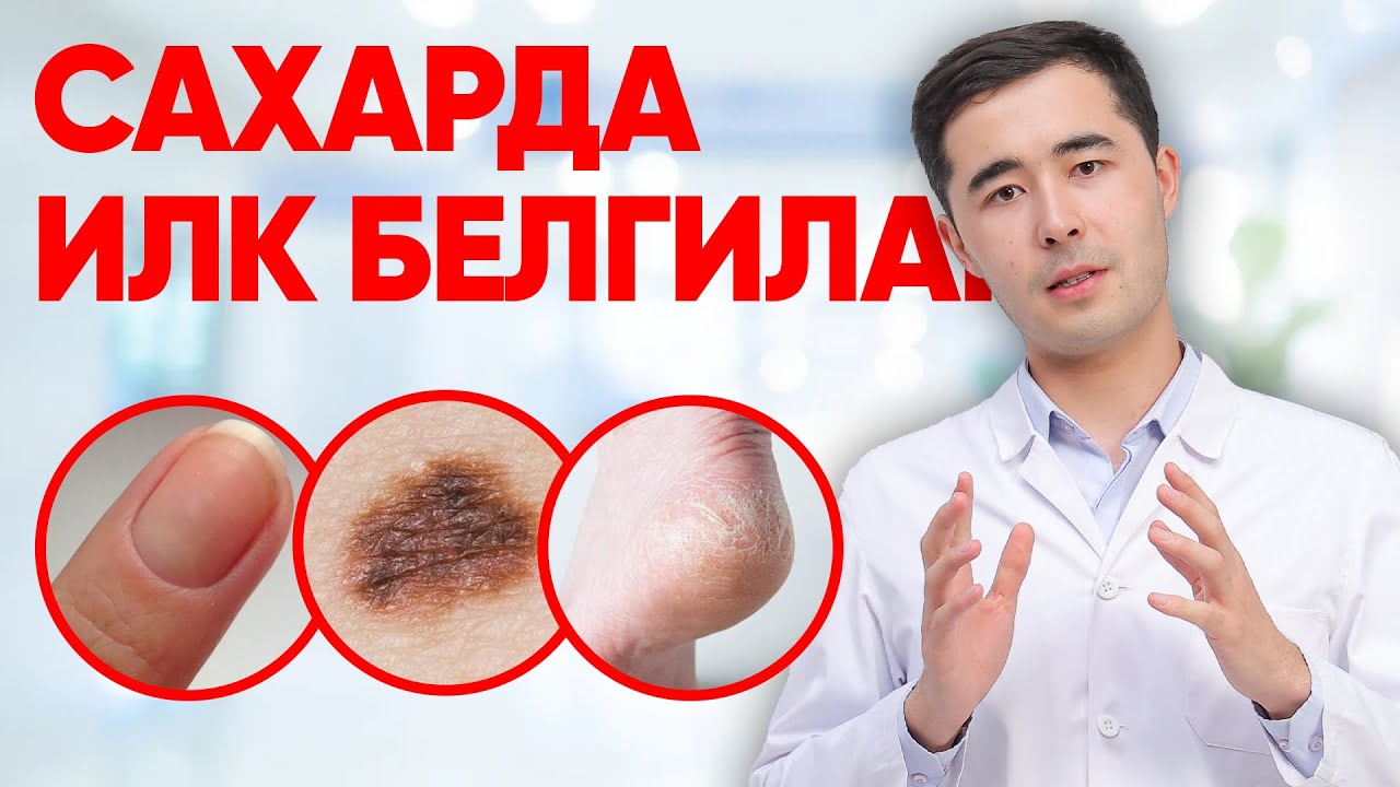 КАНДЛИ ДИАБЕТ БОШЛАНИШИ | ЯШИРИН БЕЛГИЛАР, КАНДЛИ ДИАБЕТНИ ДАВОЛАШ