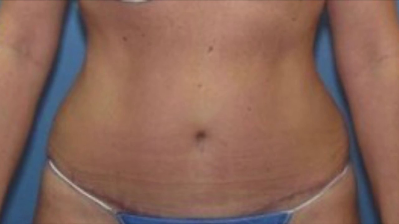 Dr. James Koehler | Before & After Video: Tummy Tuck Case #97