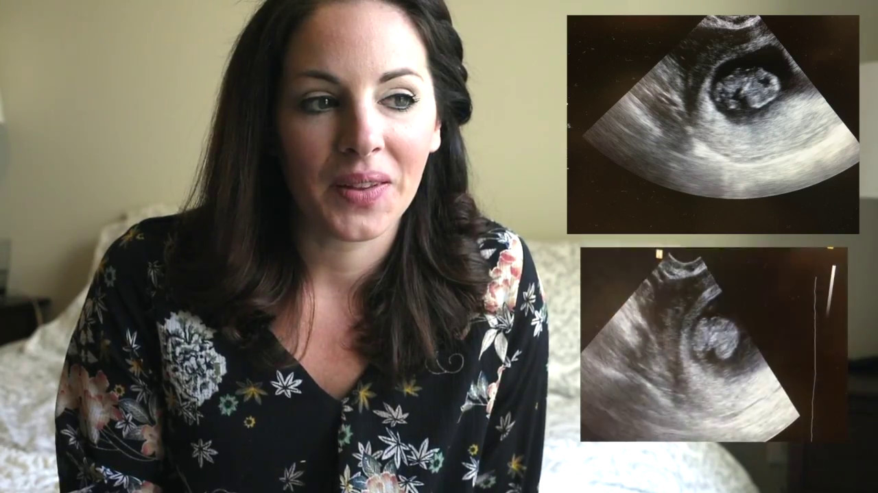 Meckel Gruber Syndrome (My Pregnancy and Loss Story)