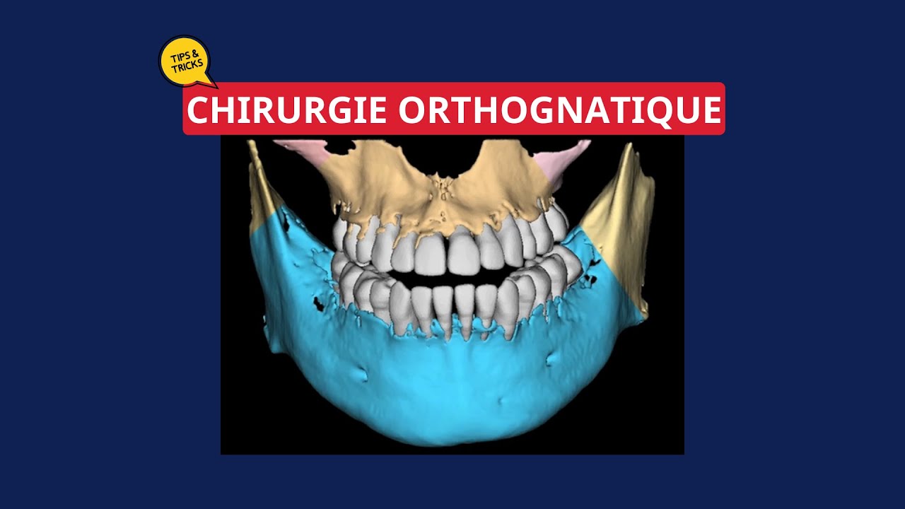 [TIPS & TRICKS]_Chirurgie Orthognatique