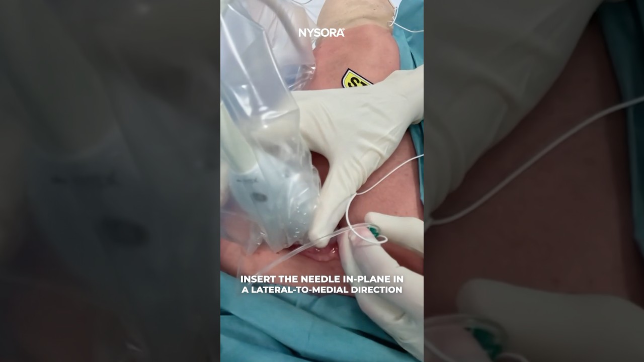 Femoral Triangle Block - Analgesia After Knee Replacement Surgery #nerveblock #knee #ultrasound