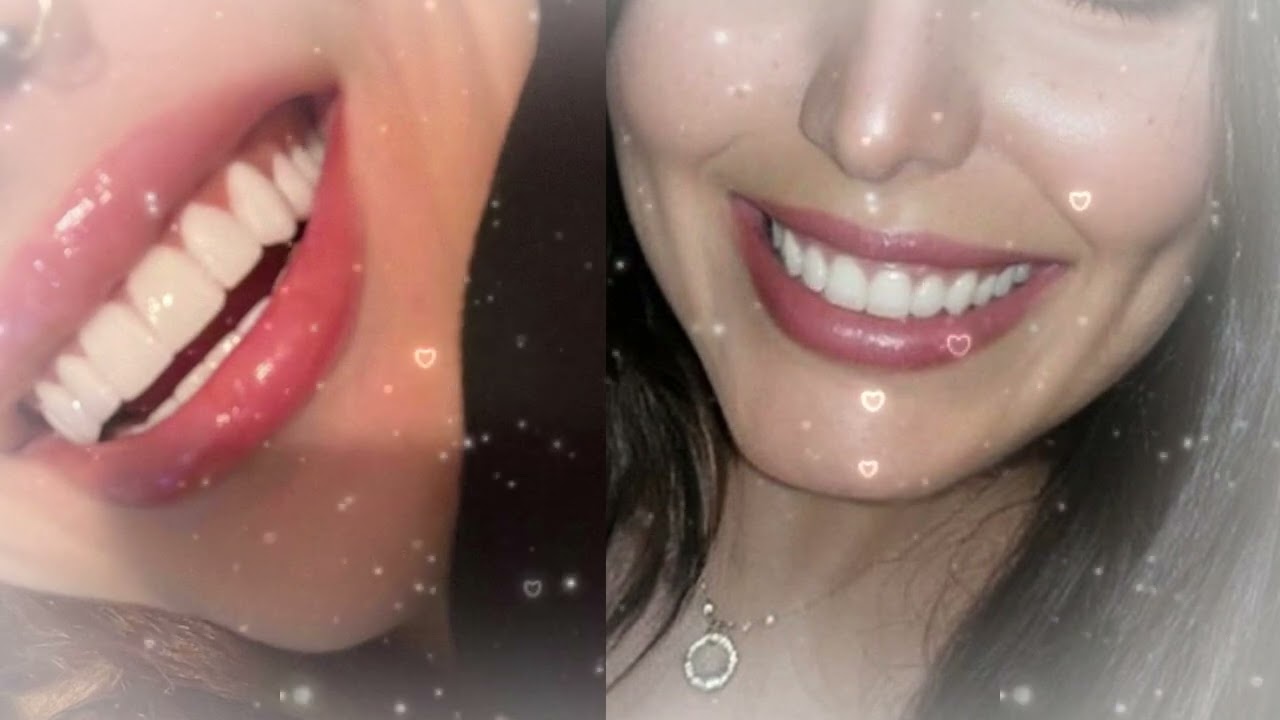 Your Teeth Are So White ~ Veneers Effect Subliminal ✨ Perfectly White, Aligned & Natural Smile Glow