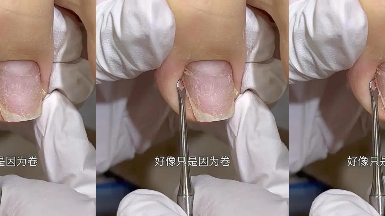 爆改这个大拇哥 #嵌甲#甲沟炎#修脚#卷甲#甲型调整