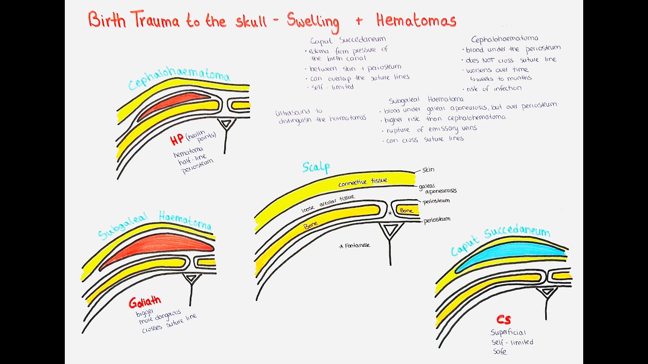Caput Succedaneum, Cephalohematoma, Subgaleal Hemorrhage