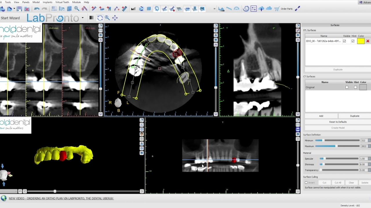 Implant planning with BSP Blue Sky Plan kuwer chani