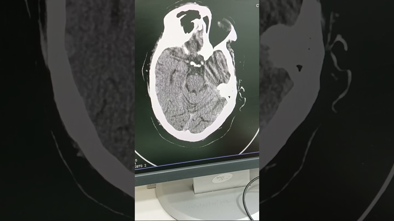 Striato-capsular Infarct