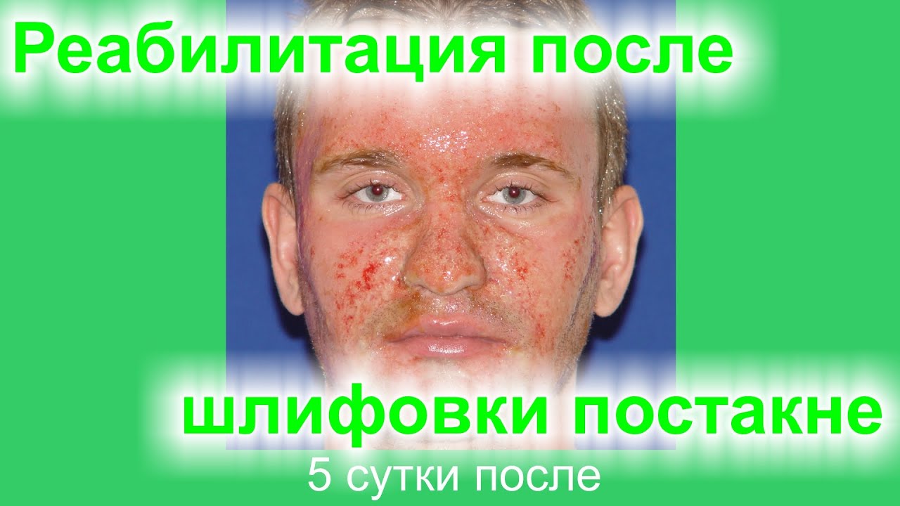 Реабилитация после лазерной шлифовки рубцов постакне. # 15