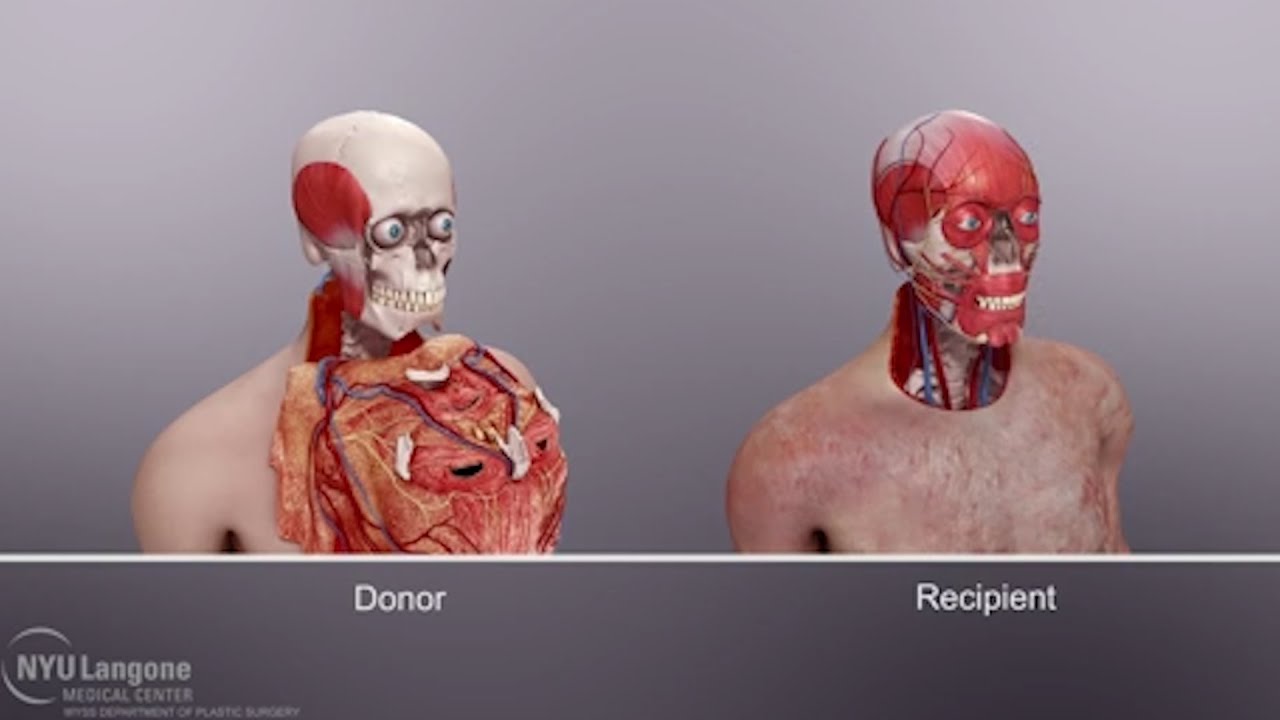 The surgeon who performed the first face transplant told us how he did it