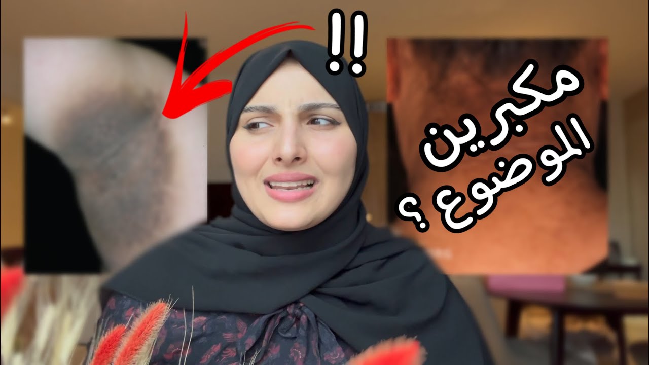 مشكلة اسمرار البشرة في مناطق الجسم .. وعدم الثقة بالنفس !! 💔👌