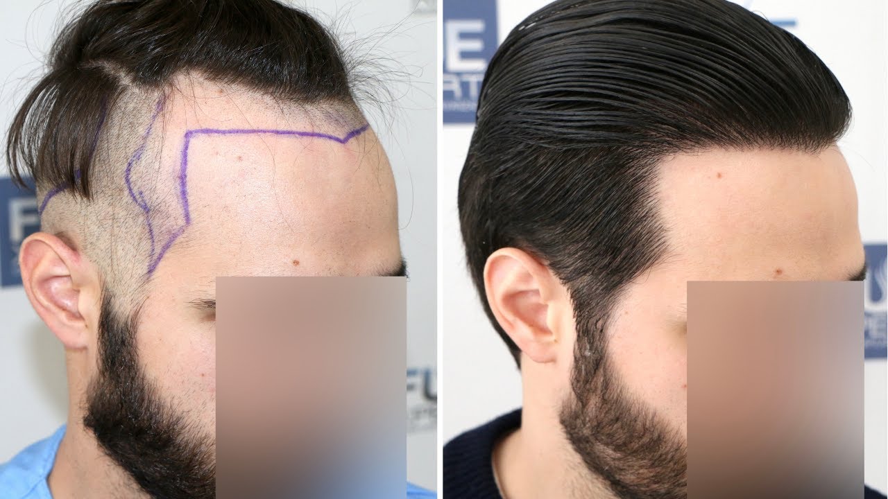Trasplante Capilar FUE de 2204 injertos por el Dr. Juan Couto en FUEXPERT CLINIC - Madrid, España