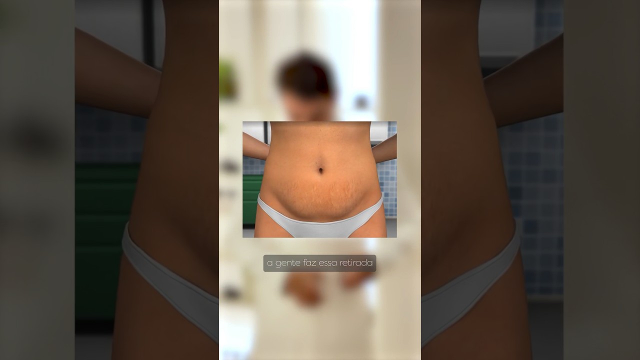 Qual a diferença entre a Abdominoplastia Total e a Mini Abdominoplastia?