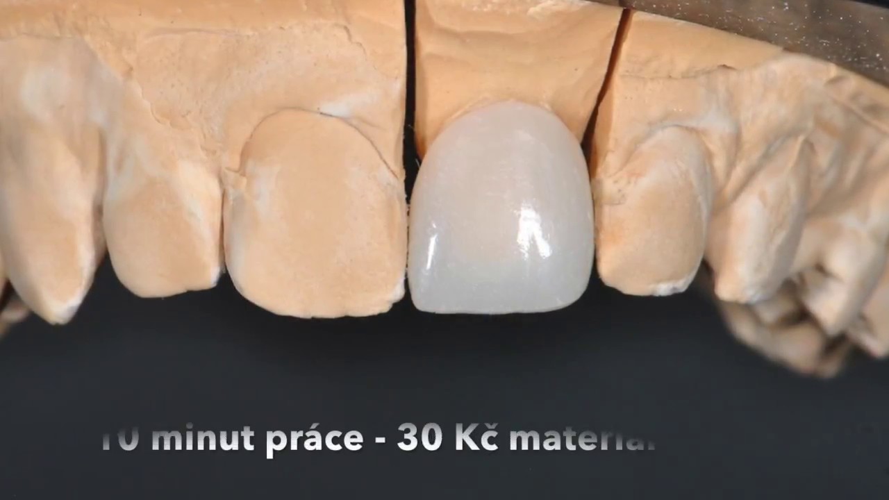 Provizorní korunka jednoduše a rychle
