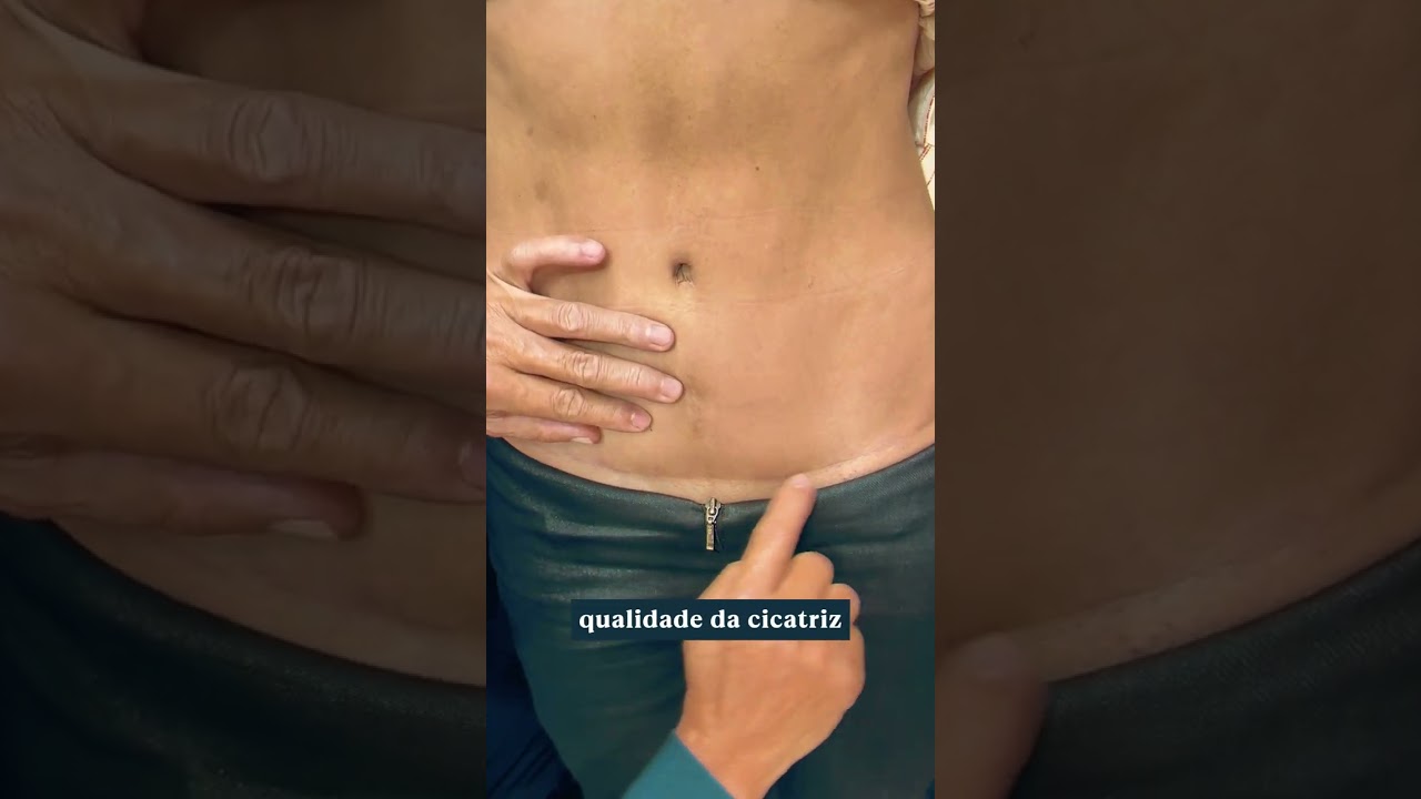 Na abdominoplastia, cada detalhe faz a diferença! 🌟