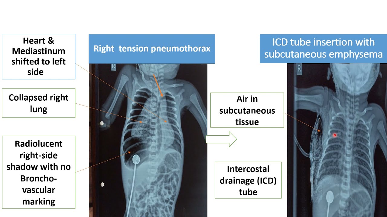 Chest X-Ray (Pleura and Mediastinum) | Pediatrics