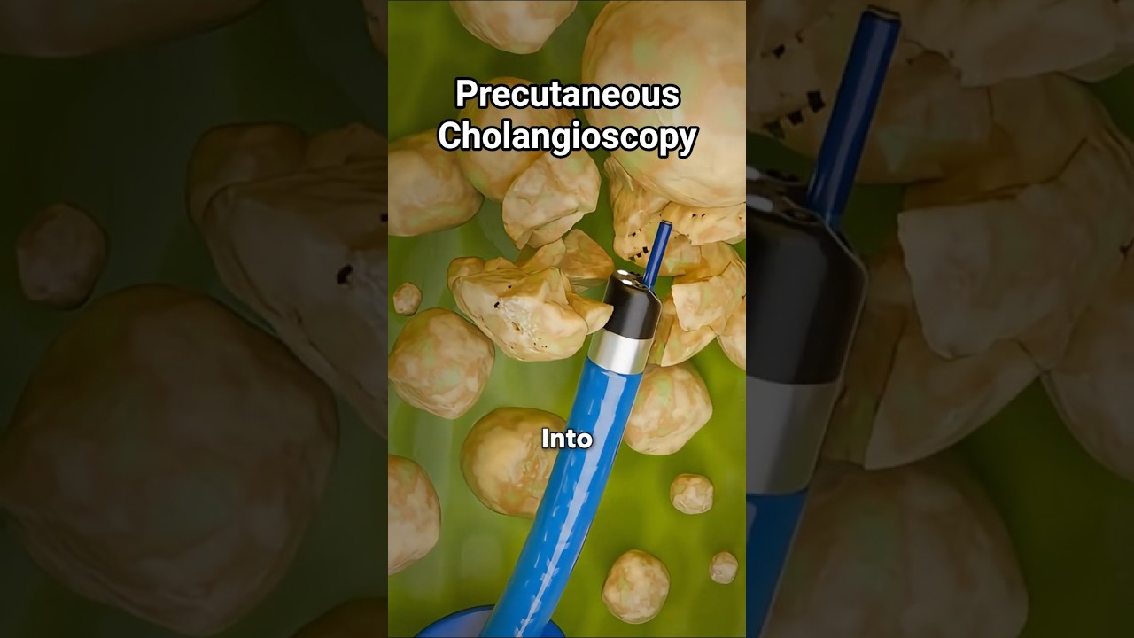 How Do Doctors Remove Gallbladder Stones Without Surgery?