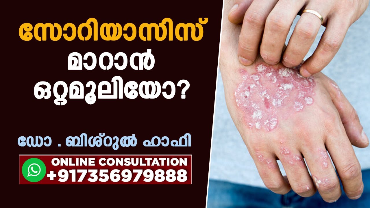 സോറിയാസിസ് മാറാൻ ഒറ്റമൂലിയോ ? | ഡോ .ബിശ്‌റുൽ ഹാഫി