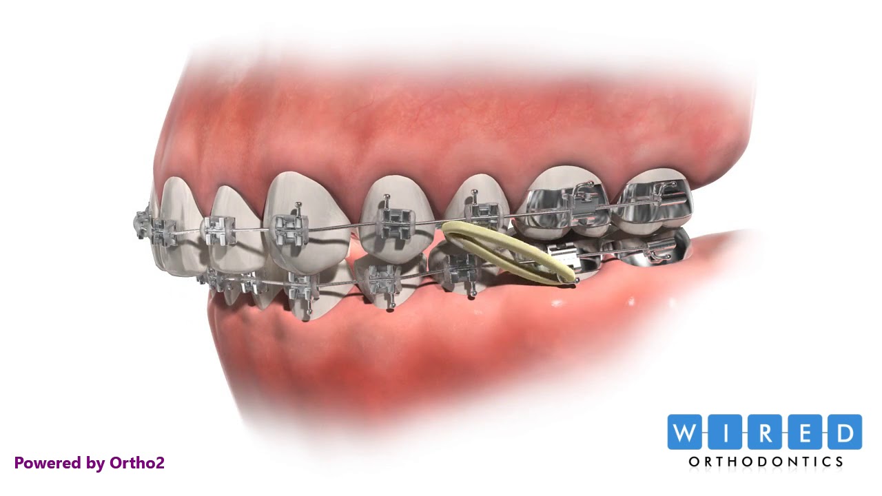 How Elastics are Used to Treat a Class II Malocclusion
