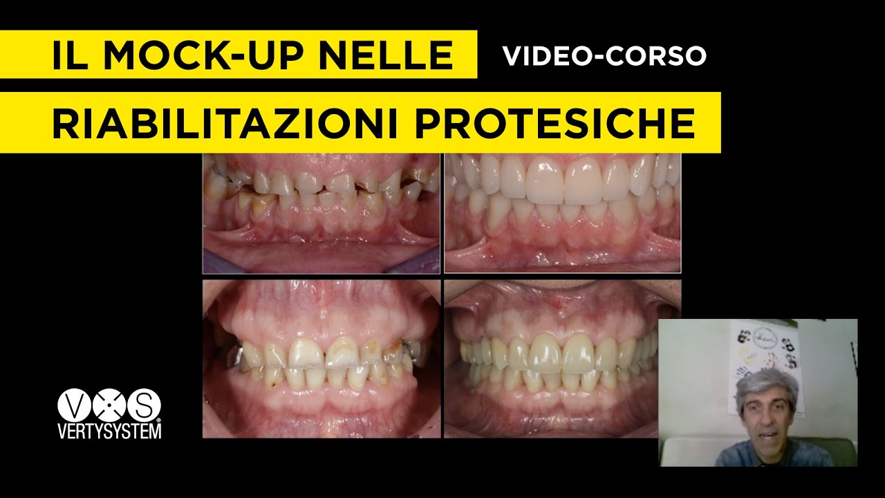 Come Eseguire i Mock-up / Provvisori nelle Riabilitazioni Protesiche