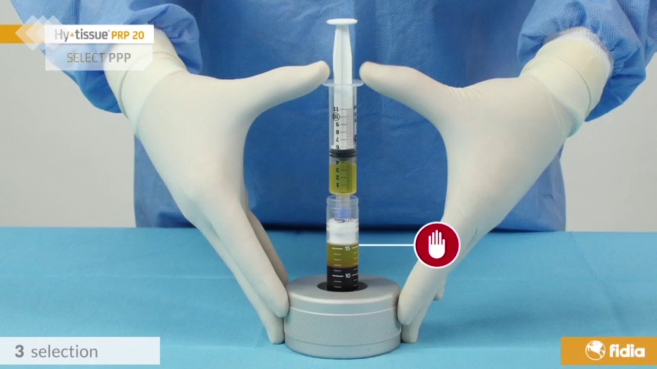 PASO A PASO PARA LA INFILTRACIÓN PLASMA RICO EN PLAQUETAS