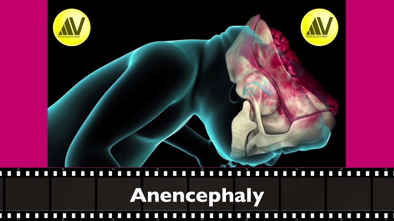 Anencephaly Explained