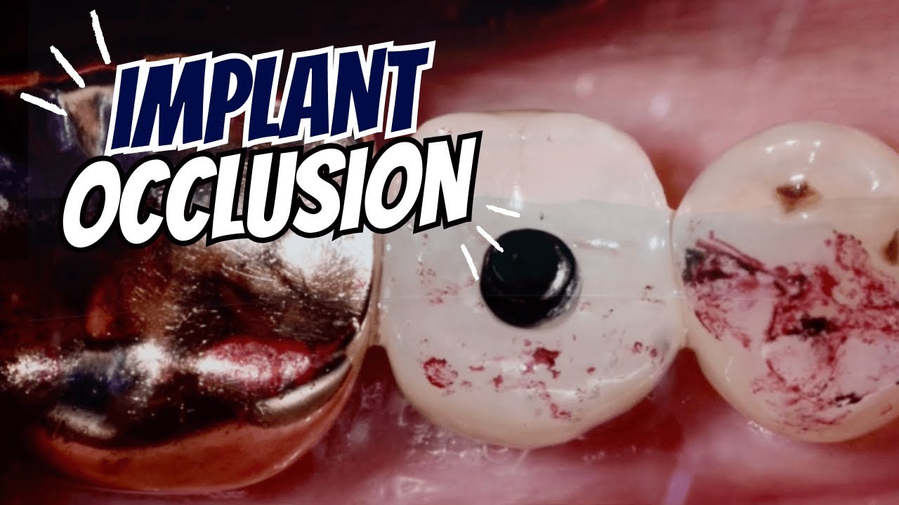 Implant Occlusion that Makes Sense! - PDP204