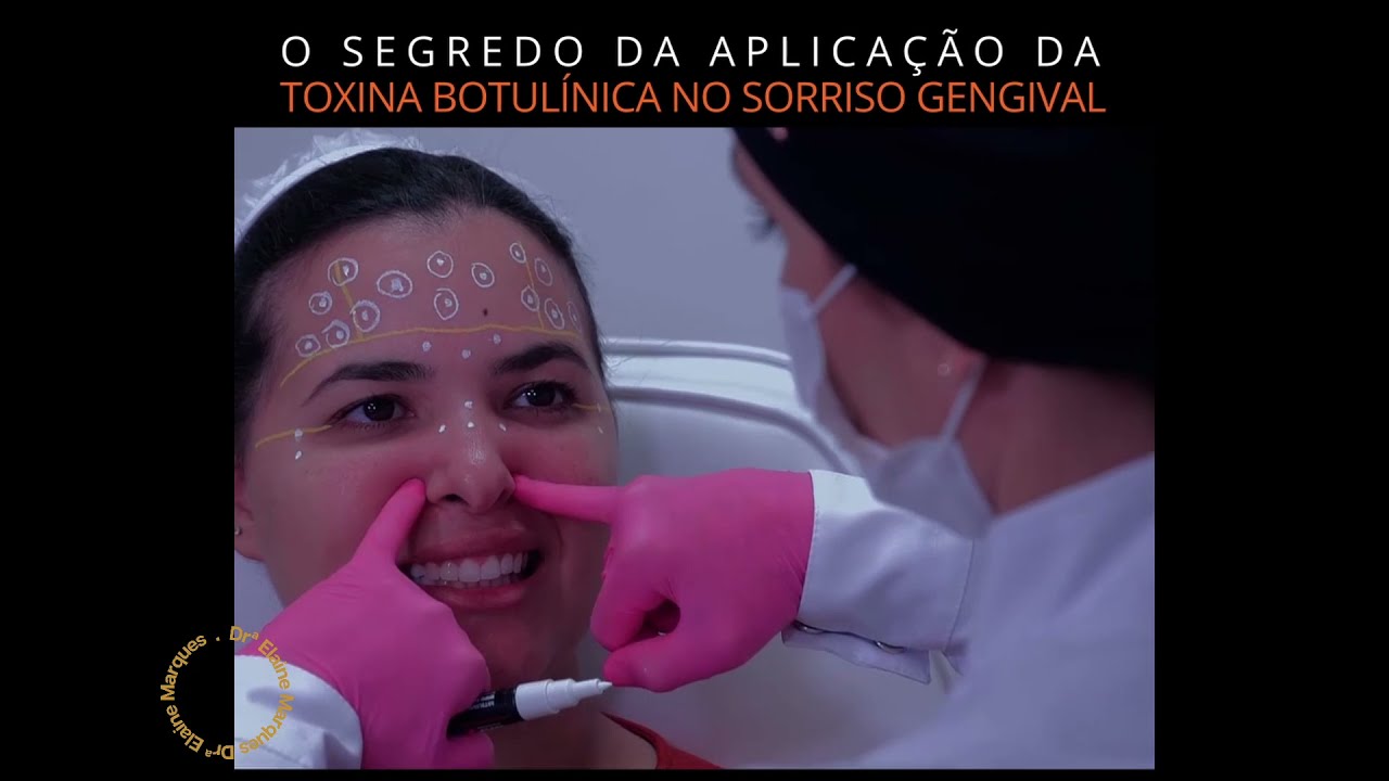 O SEGREDO DA APLICAÇÃO DA TOXINA BOTULÍNICA NO SORRISO GENGIVAL