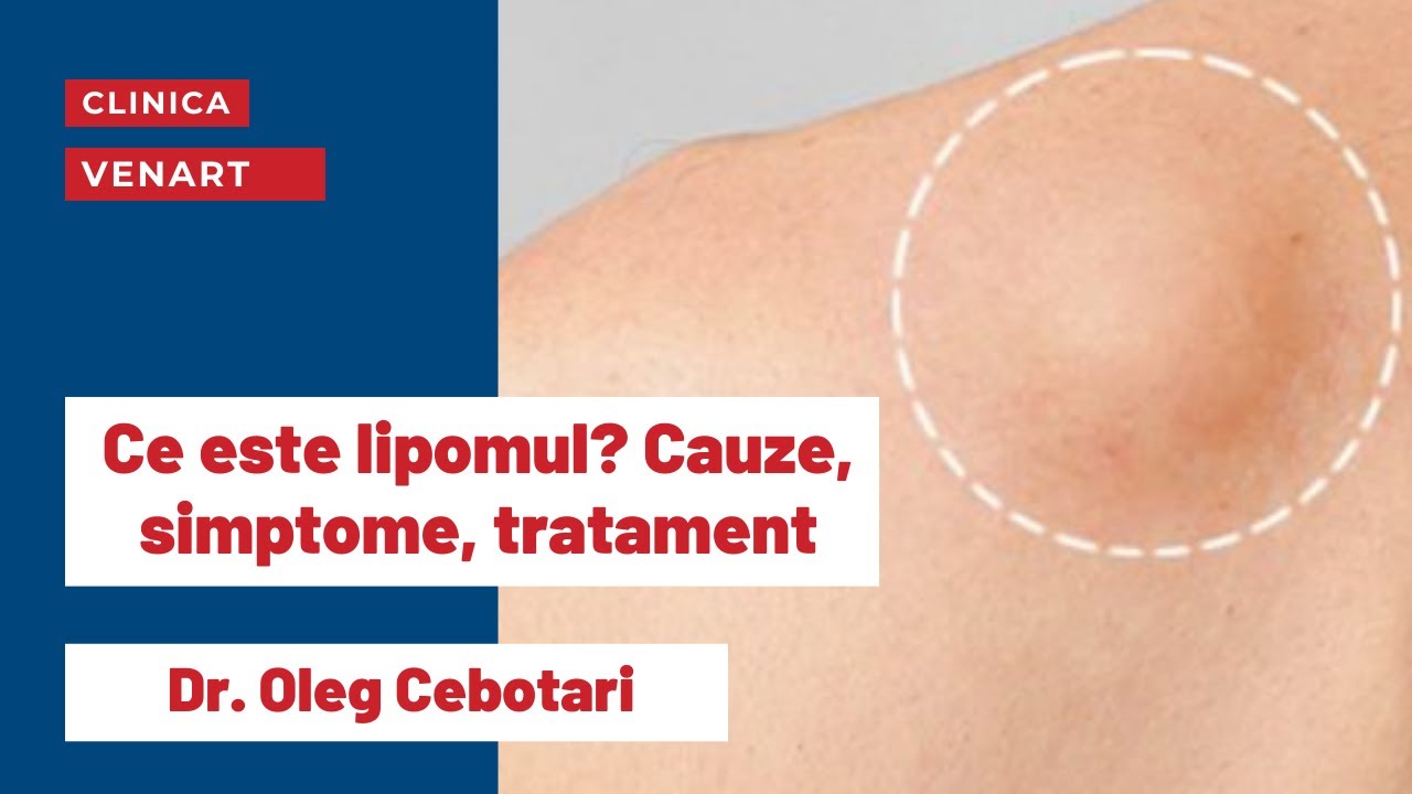 Lipomul - Tot ce trebuie sa stii. Cauze, simptome, tratament | Dr. Oleg Cebotari
