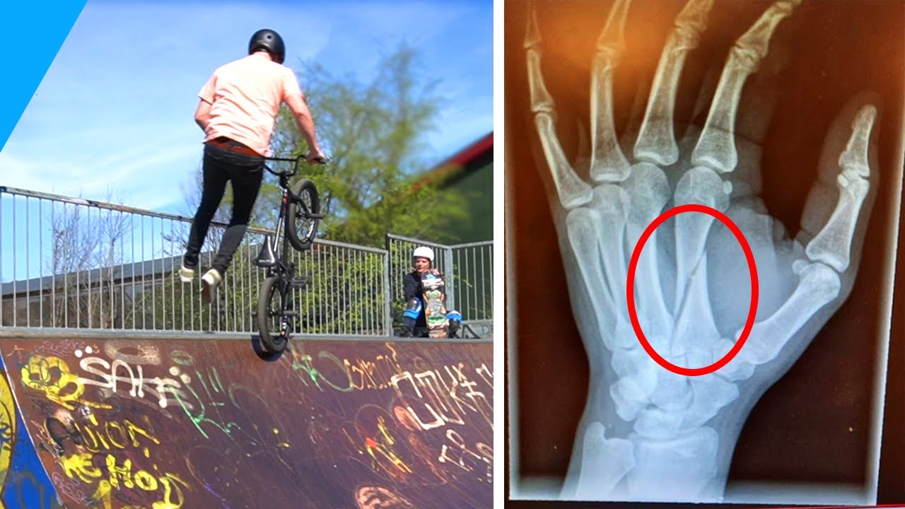 HAND GEBROKEN MET BMX! - Cromo Vlog #55