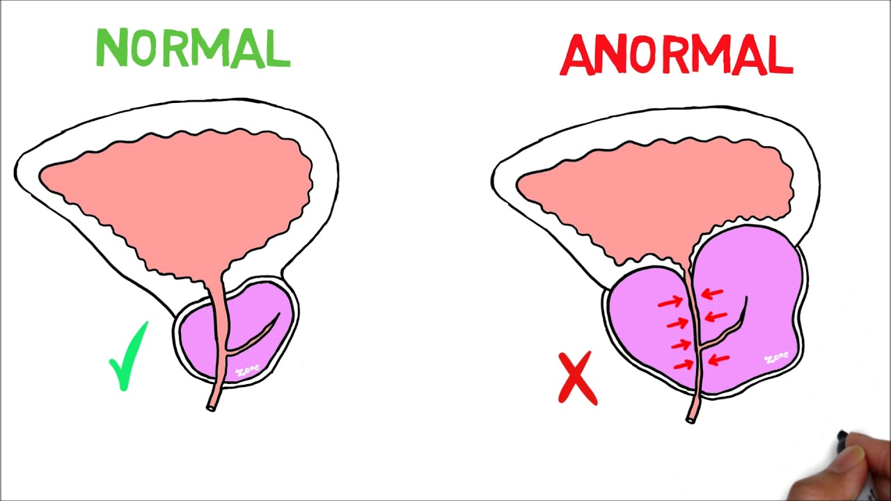 Hiperplasia prostática benigna (HPB) Fisiopatología, Anatomía y Síntomas.