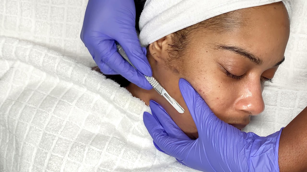 Dermaplaning Facial | Best Facial For Acne Scars & Brighter Skin