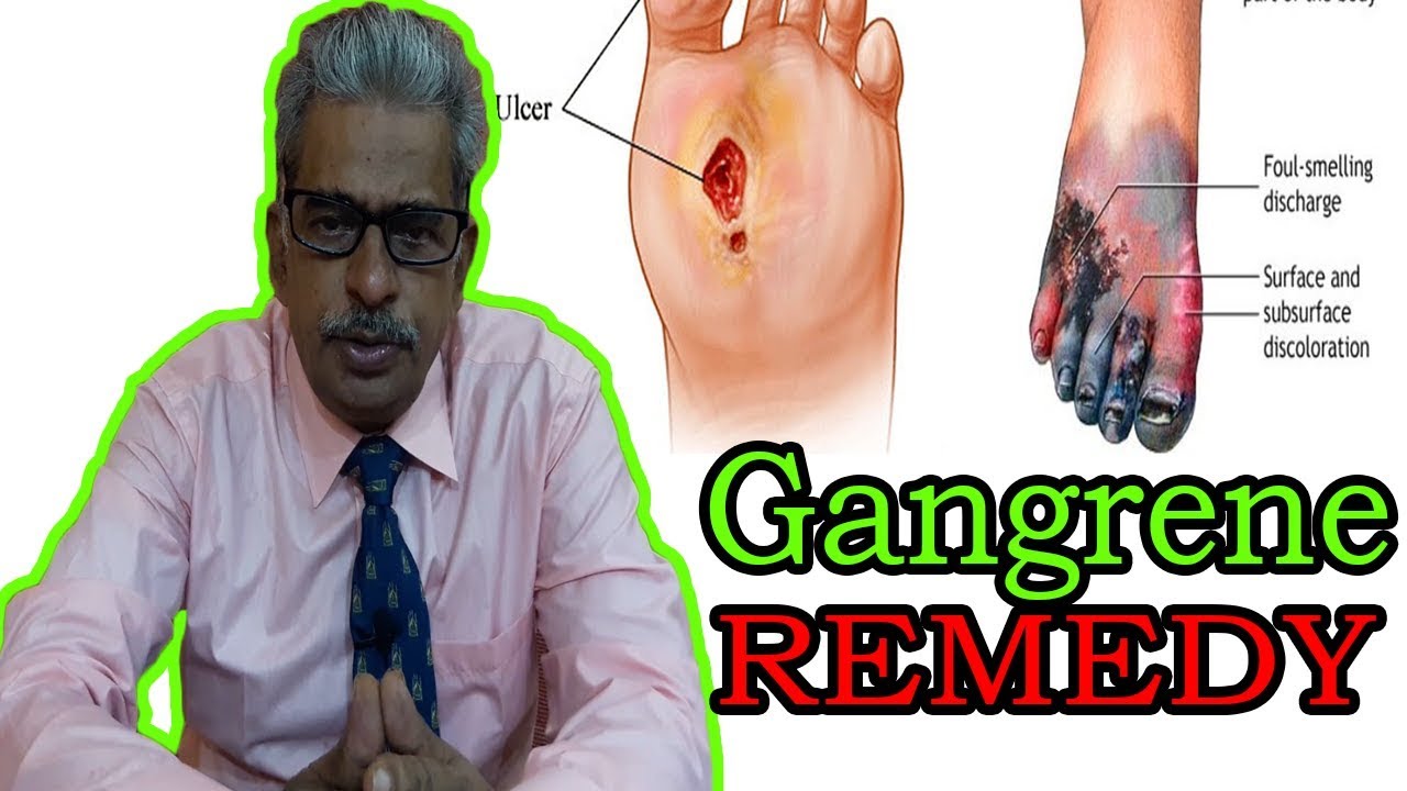 Gangrene in Hindi - Discussion and Treatment in Homeopathy by Dr P.S. Tiwari