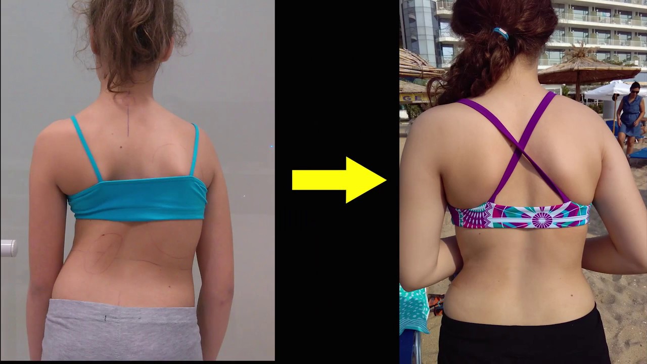 Advice and motivation for wearing your scoliosis brace