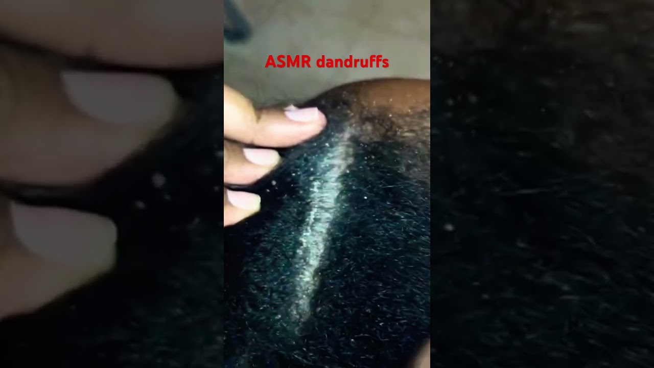 ASMR dandruffs scratch #asmr #haircare