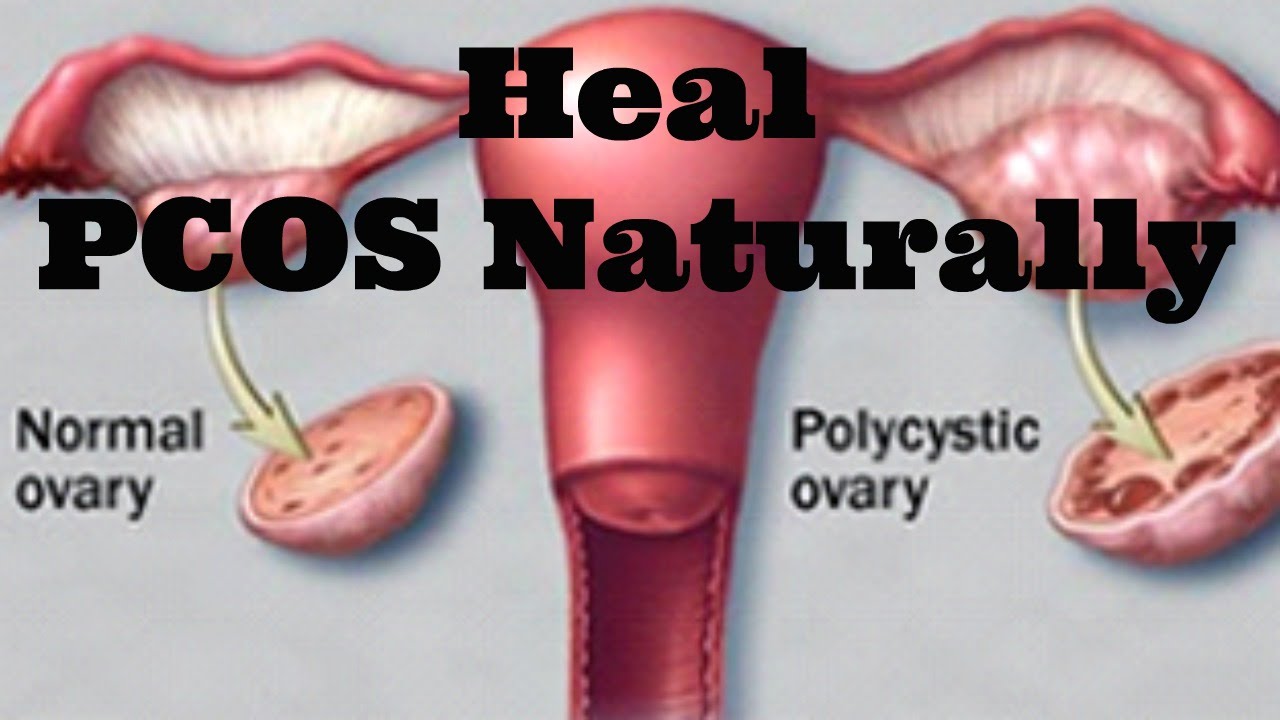 How to Heal PCOS Naturally (Diet, Exercise & Lifestyle)