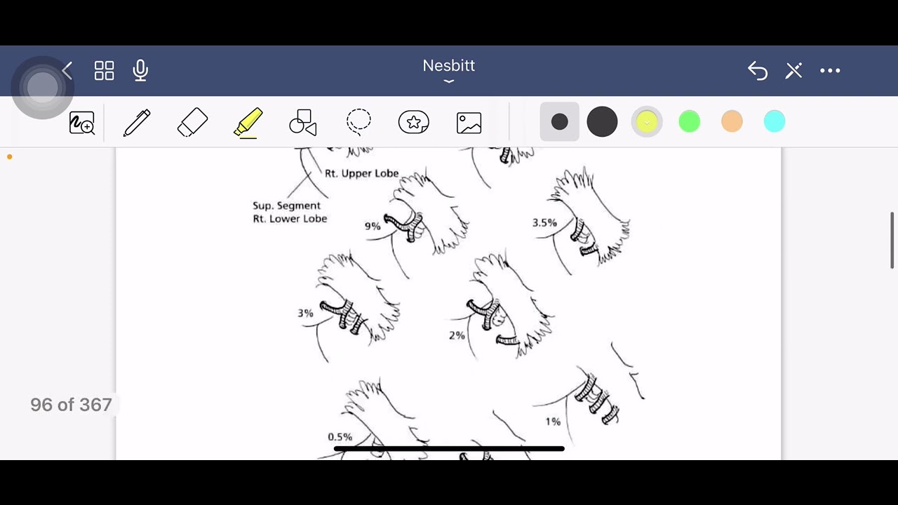 Nesbitt Right lower lobectomy
