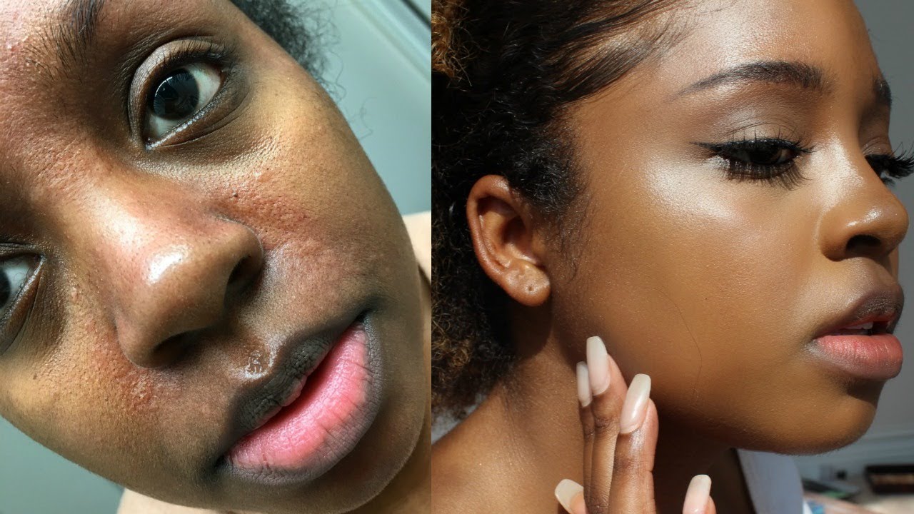 HOW I CLEARED MY SKIN IN 1 WEEK