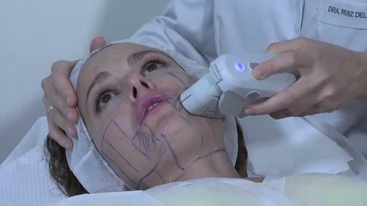 Clinica Mira+Cueto SMAS ULTRA LIFT
