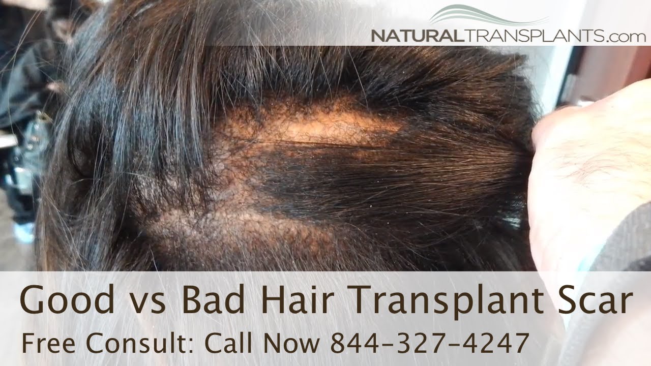Hair Transplant Scar: Good Vs Bad Hair Transplant Scar | Natural Transplants Scars