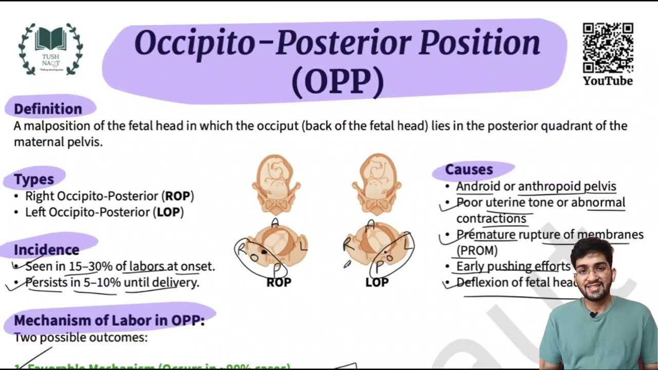 Occipito Posterior Position - Malposition