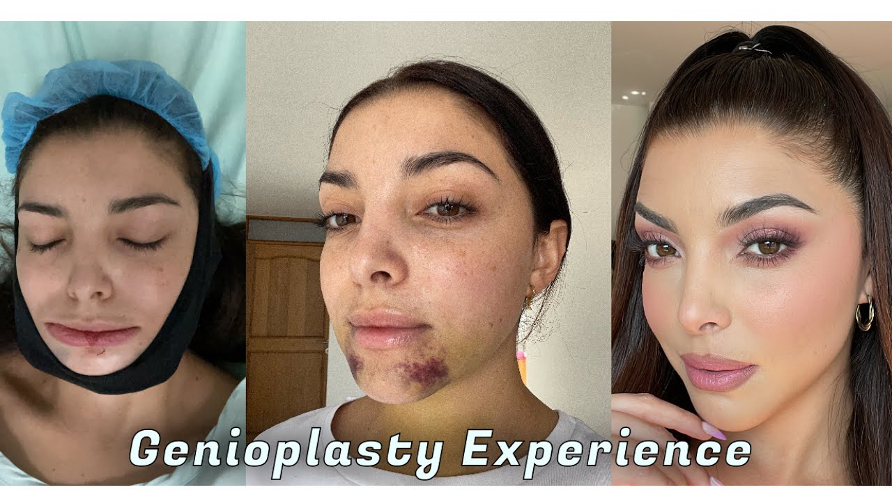 GENIOPLASTY SURGERY MY EXPERIENCE