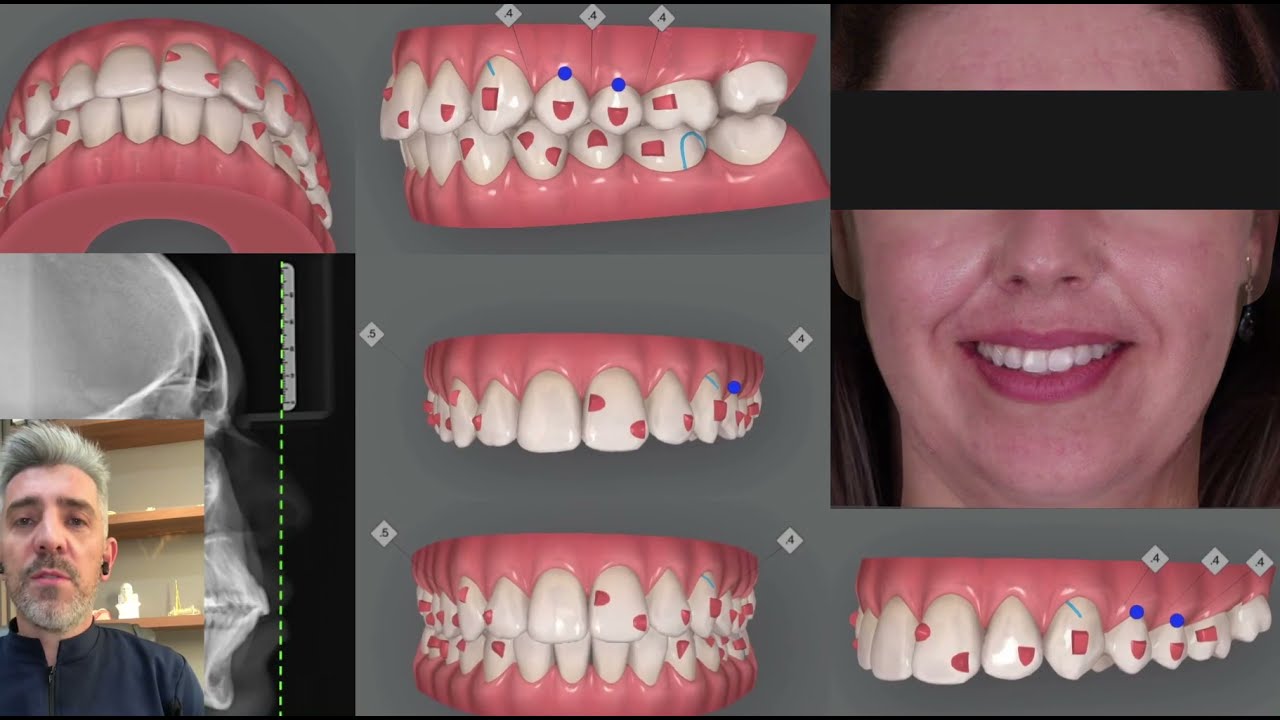 Invisalign - Relato de caso clínico 2